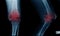 severe OA knee x-ray image on blue color with black background