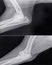 Severe osteoarthritis in the elbow of an older dog