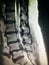 Severe spinal canal stenosis pathology mri exam