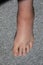 severe swelling and hematoma of the left foot