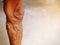 The severity of the varicose veins ranges from the tiny capillaries, pain in the legs, swollen feet and legs, and the crooked