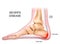 Severs disease. calcaneus apophysitis. inflammation at the back of the heel growth plate