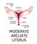 The shape of the uterus, the female reproductive organ. normal, mild arcuate, moderate, severe