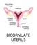 The shape of the uterus, the female reproductive organ. normal, mild arcuate, moderate, severe