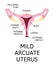 The shape of the uterus, the female reproductive organ. normal, mild arcuate, moderate, severe