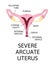 The shape of the uterus, the female reproductive organ. normal, mild arcuate, moderate, severe