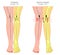 Shapes of the legs.Normal and curved legs.Knock knees.Bowed leg