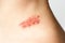 Shingles on child herpes zoster