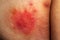 Shingles disease. Sympton of the Herpes virus on the human body. Skin rash and blisters on the body