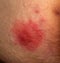 Shingles disease. Sympton of the Herpes virus on the human body. Skin rash and blisters on the body