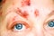Shingles on the Face and Around the Eye, Called ophthalmic herpes zoster or herpes zoster ophthalmicus