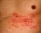 Shingles - herpes zoster