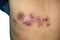 Shingles or herpes zoster infection in chest of Southeast Asian adult man. They appear as a single stripe of blisters.