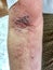 Shingles or herpes zoster infection in left arm of Southeast Asian adult man.