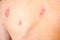 Shingles on men herpes zoster. Closeup.