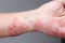 Shingles, Zoster or Herpes Zoster symptoms on arm