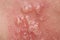 Shingles, Zoster or Herpes Zoster symptoms on arm