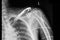 A shouder film xray of a patient with fractured clavicle