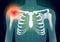 Shoulder bone have a red signal