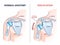 Shoulder dislocation and humerus bone trauma explanation outline diagram