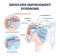 Shoulder impingement syndrome from rubbing rotator cuff outline diagram