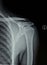 Shoulder joint X-ray