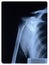 Shoulder X-ray