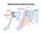 Shoulder subluxation as partial dislocated arm joint problem outline diagram