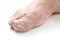 Sick nail on the foot. Toenail fungus isolated on white. Sore toenail, nail fungus close up photo