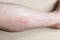 Side of male shin with itchy red rash