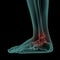 Side x-ray view of human painful foot and ankle