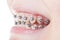 Side view of dental braces on teeth close up
