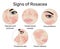 Signs of Rosacea