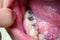 Silver amalgam fillings at right lower first molar and left lower second premolar teeth in Asian, young man. poor oral hygiene