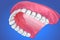 Single Missing Tooth - Removable partial denture