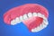 Single Missing Tooth - Removable partial denture .  illustration