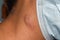 Single swelling or lymph node at the neck