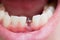 Single tooth implant