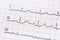 Sinus Heart Rhythm On Electrocardiogram Record Paper Showing Normal Heart