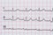 Sinus Heart Rhythm On Electrocardiogram Record Paper Showing Normal Heart