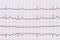 Sinus Heart Rhythm On Electrocardiogram Record Paper Showing Normal Heart