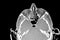 Sinus SCAN of patient with sinus infection