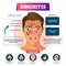 Sinusitis vector illustration. Labeled rhinosinusitis inflammation scheme.