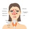 Sinusitis, Woman\\\'s face with inflammation of the mucous membrane of the paranasal and frontal sinuses.