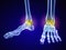 Skeletal foot - injuryd talus bone. Medically accurate 3D illustration