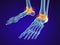 Skeletal foot - injuryd talus bone. Xray view. Medically accurate illustration