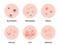 Skin acne types diagram. Vector skin disease pimples blackheads and comedones, cosmetology and skincare problems treatment