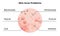 Skin acne types diagram. Vector skin problems disease, pimples blackheads and comedones, cosmetology skincare treatment