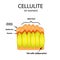 Skin aging in women. Cellulitis. Infographics. Vector illustration on background
