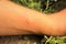 Skin allergy. Yellow wasp: stung by a wasp worker. Hornet stings a man`s arm